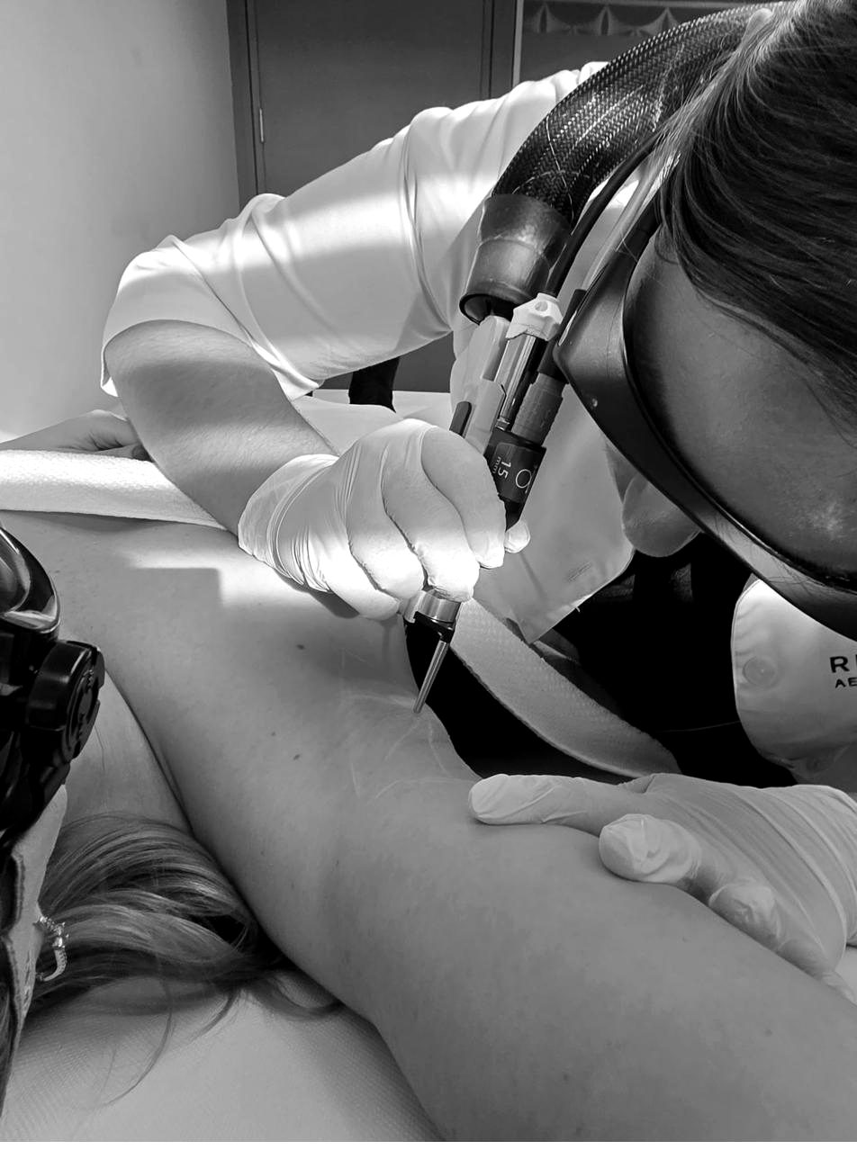 Traitement laser du visage pendant la formation peau et pigmentation