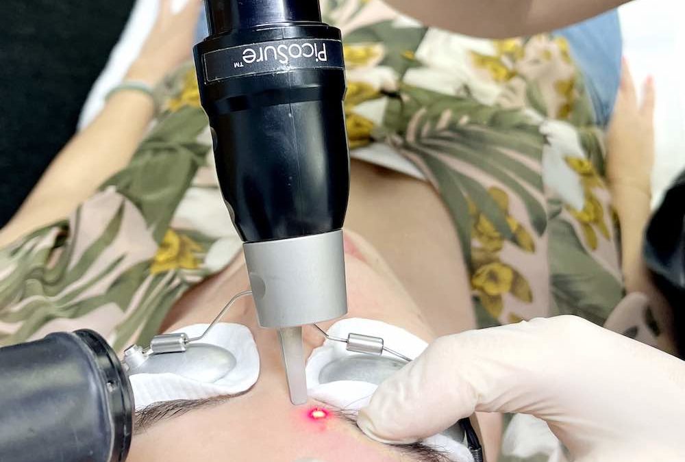 Dégagement gazeux et particulaire lors du détatouage au laser.